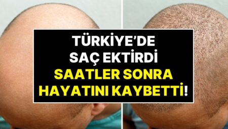 İngiltere’den Türkiye’ye Saç Ektirmeye Gelen Hasta Ameliyat Sonrası Hayatını Kaybetti
