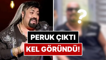 Peruk Düştü Kel Göründü: Protez Saçı Yüzünden Enfeksiyon Kapan Kobra Murat’ın Saçsız Hali Ortaya Çıktı!